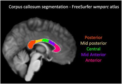 Topology of diffusion changes in corpus callosum in Alzheimer's disease: An exploratory case-control study